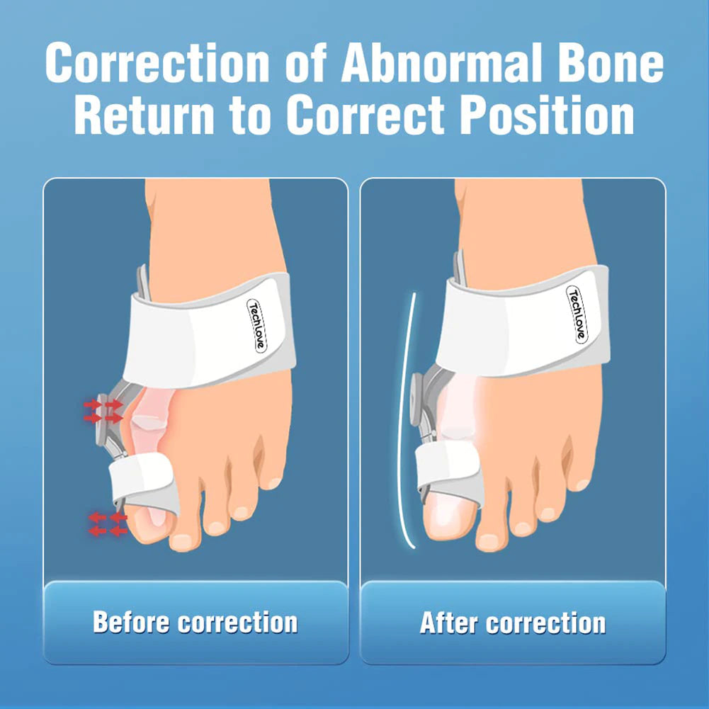 Hallux Valgus Bunion Corrector Orthotics Feet
